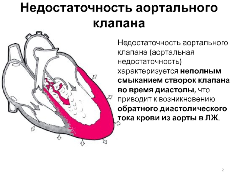 Митральный аортальный стеноз. Схема створок митрального клапана. Недостаточность аортального клапана порок сердца. Аортальный стеноз гемодинамика. Стеноз аортального клапана схема.