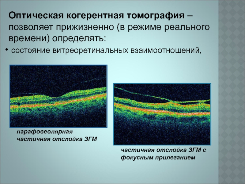 Оптическая когерентная томография схема