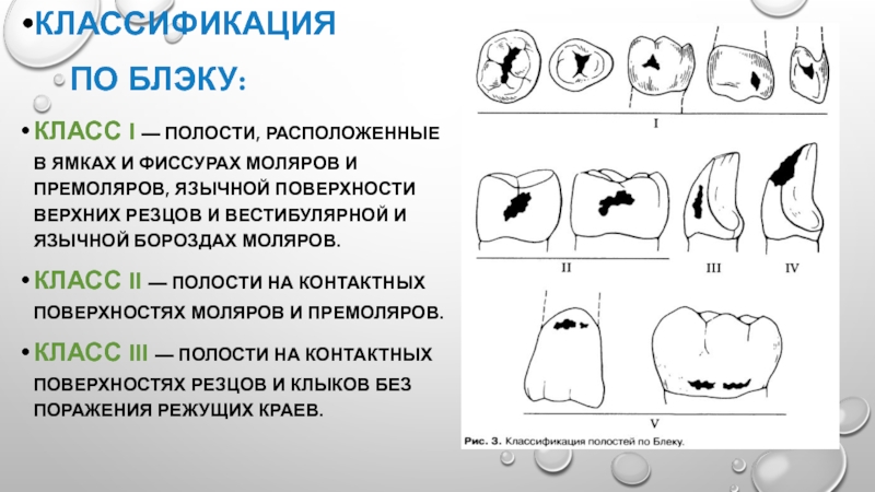 Кариес определение этиология классификация стадии макроскопическая картина осложнения и исходы