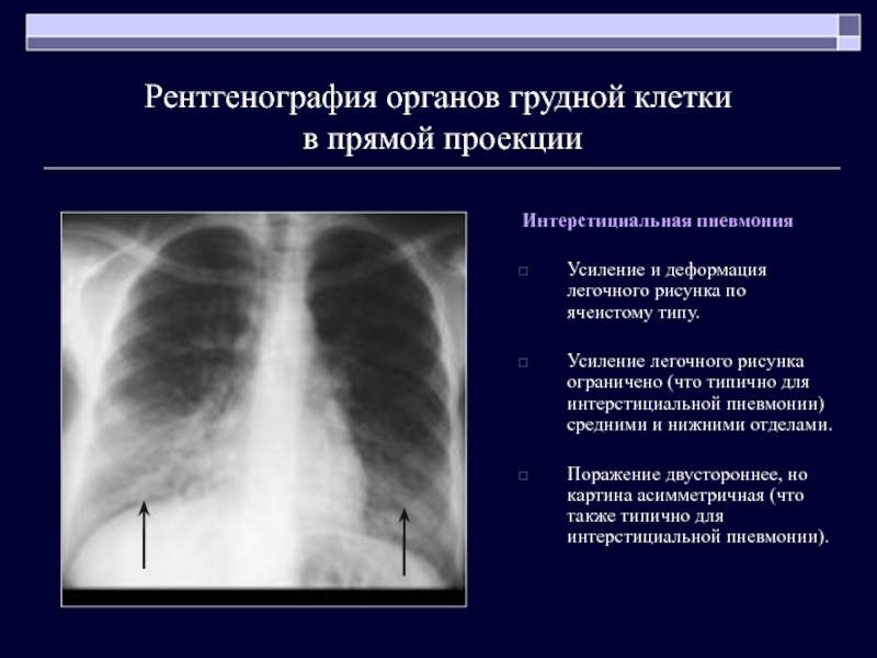 Легочный рисунок несколько деформирован