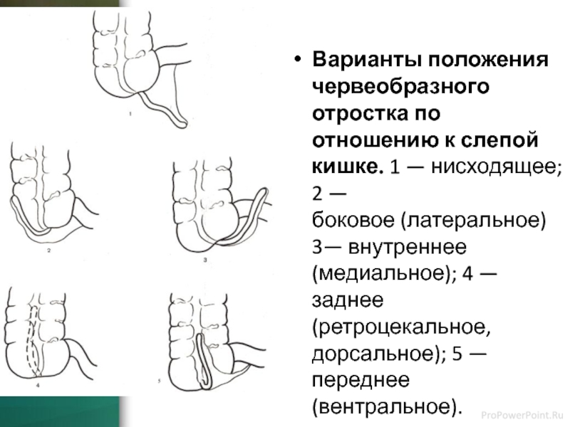 Варианты положения. Варианты положения аппендикулярного отростка. Положение червеобразного отростка к слепой кишке. Червеобразный отросток анатомия расположение. Типичное расположение червеобразного отростка.