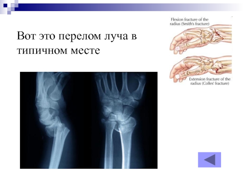 Перелом луча в типичном месте карта вызова скорой помощи локальный статус