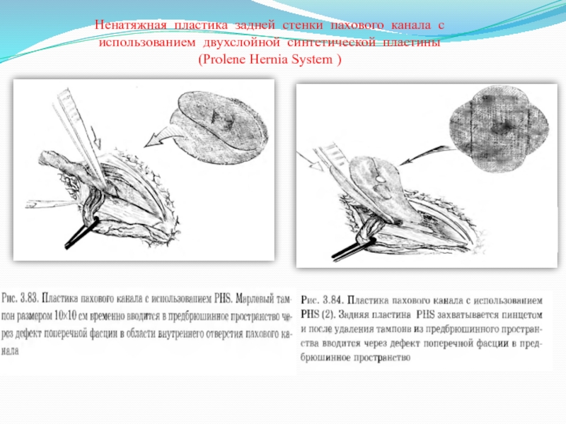 Пластика задней. Пластика задней стенки пахового канала. Prolene Hernia System. Ненатяжные способы пластики пахового канала.