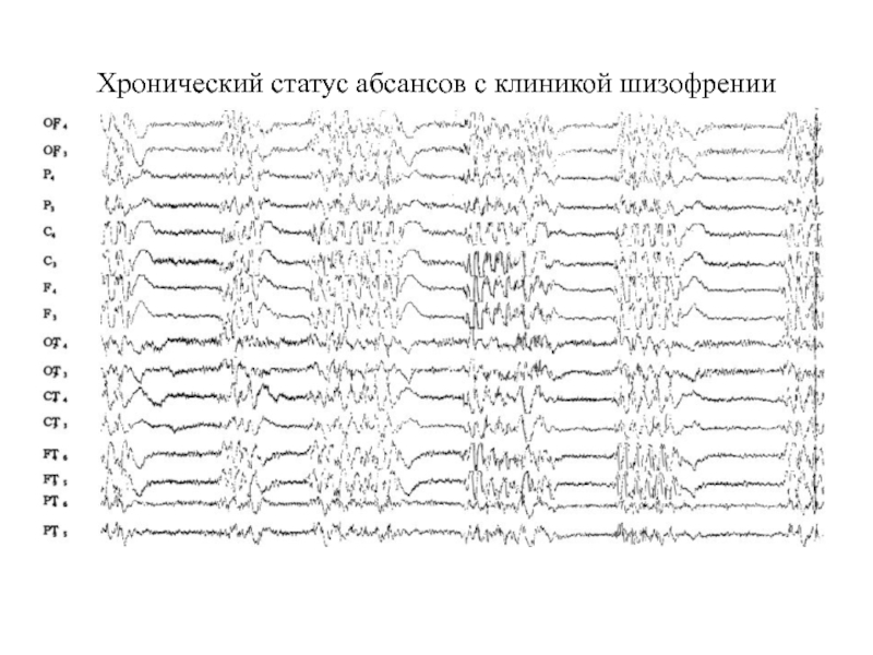ЭЭГ В абсанс. ЭЭГ при шизофрении расщшифка пример. Атипичный абсанс на ЭЭГ. Типичный абсанс на ЭЭГ У ребенка.