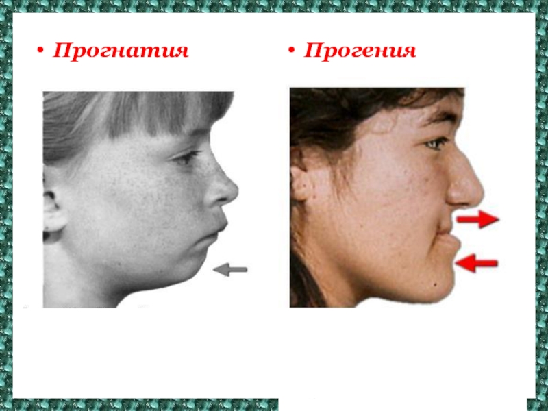 Прогения и прогнатия картинки