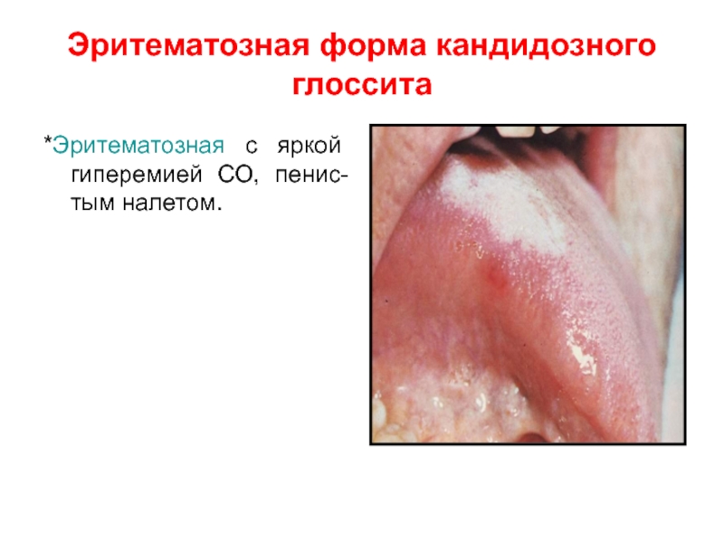 Кандидозный глоссит фото лечение