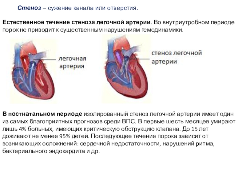 Стеноз это. Легочная артерия ребенка степе.