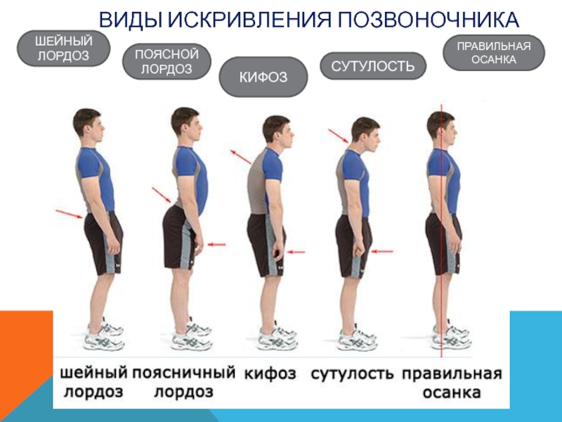 Какие виды осанки. Нарушение осанки лордоз кифоз сколиоз. Искривленная осанка сбоку. Сутулость вид сбоку. Нормальный позвоночник вид сбоку.