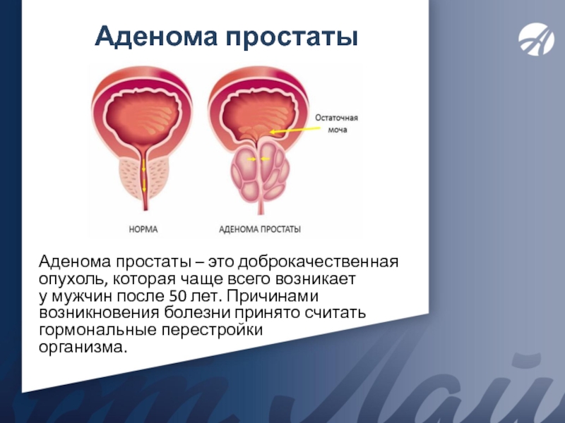 Аденома простаты у мужчин лечение. Доброкачественная опухоль простаты. Доброкачественная опухоль простаты у мужчин. Операция тур аденомы простаты.