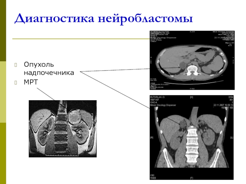 Нейробластома у детей презентация