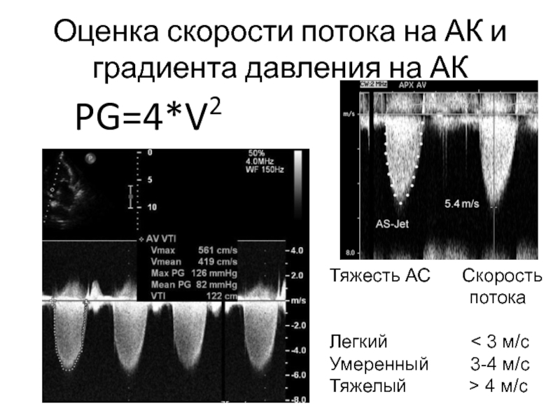 Градиент давления. Средний градиент давления на аортальном клапане. Градиент давления на митральном клапане. Эхо кг градиент давления.