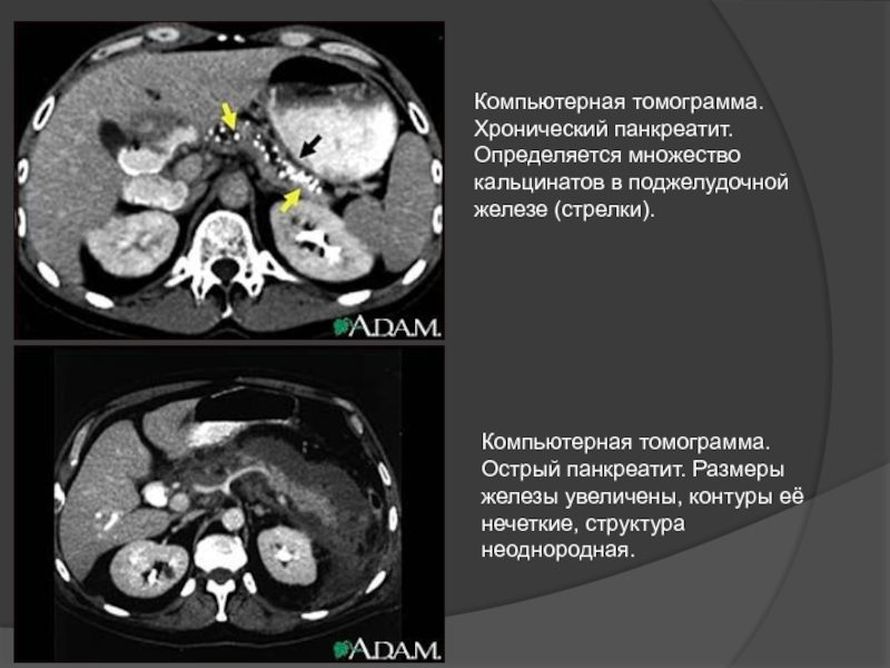 Кт картина панкреатита