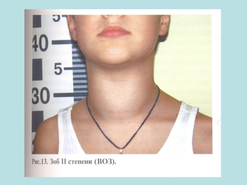 Щитовидная железа у детей 10 лет. Эндемический зоб щитовидной. Зоб 1 степени щитовидной железы что это. Диффузный эндемический зоб 1 степени.