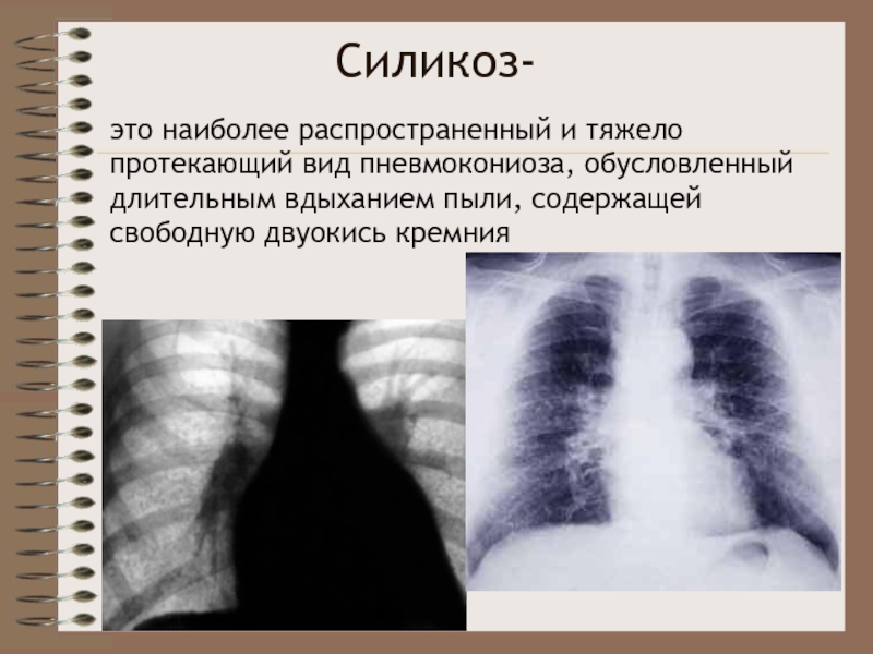 Нехарактерным для клинической картины неосложненного силикоза является