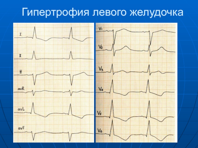 Схема гипертрофия левого желудочка