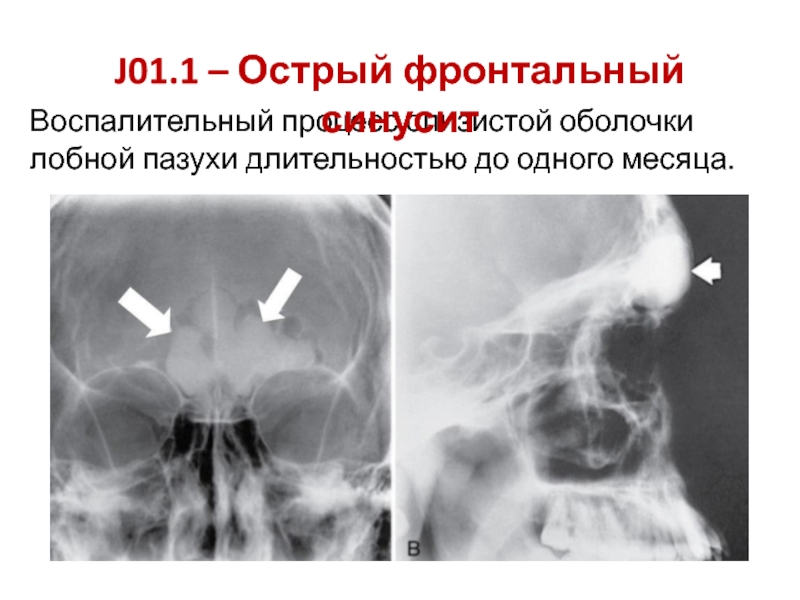 Реферат: Острый левосторонний гнойный фронтит 2