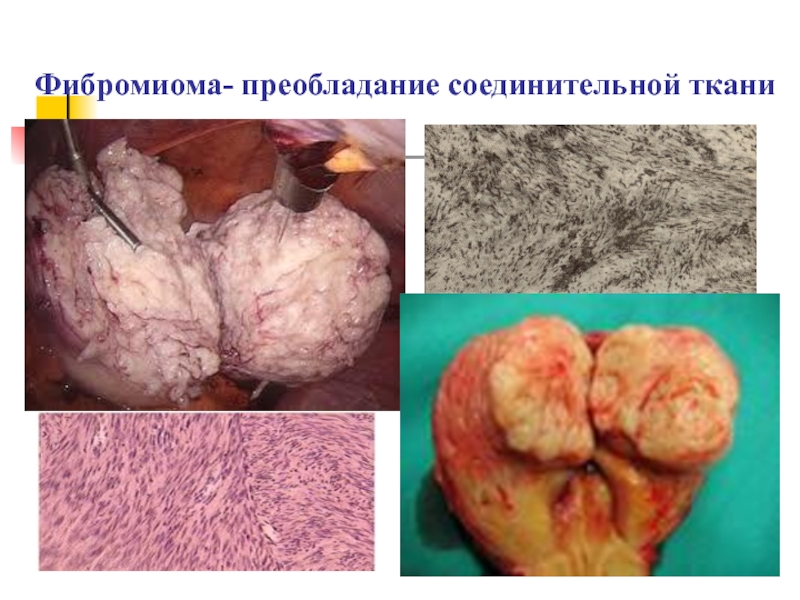 Фибромиома- преобладание соединительной ткани