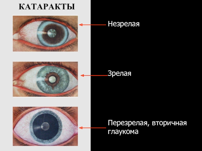 Вторичная катаракта. Морганиевая катаракта. Перезрелая катаракта этапы.