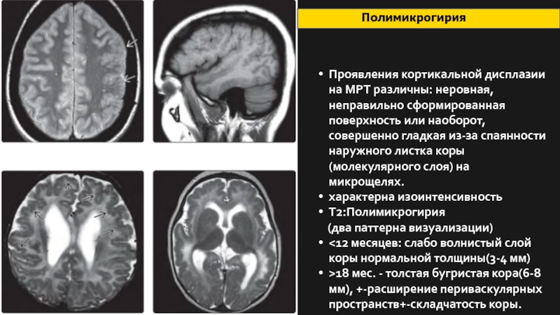 Признаки атрофии мозга. Микрогирия мрт. Полимикрогирия головного мозга мрт. Пахигирия и полимикрогирия. Атрофия головного мозга на кт.