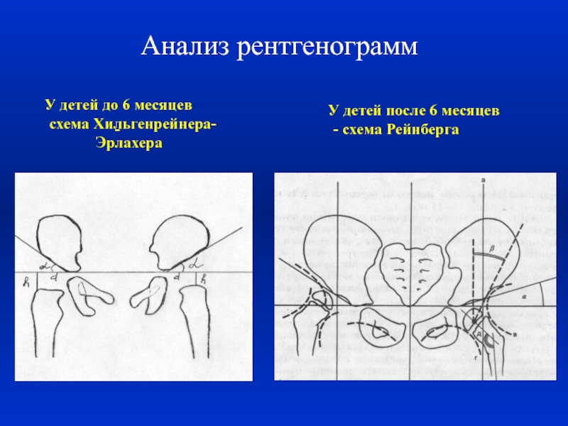 Схема врожденного вывиха бедра