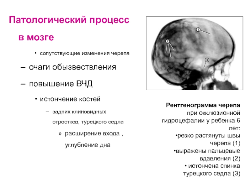 Шишковидная железа обызвествление. Обызвествление шишковидной железы рентген черепа. Обызвествление шишковидной железы рентген. Истончение костей черепа. Очаги обызвествления в головном мозге.