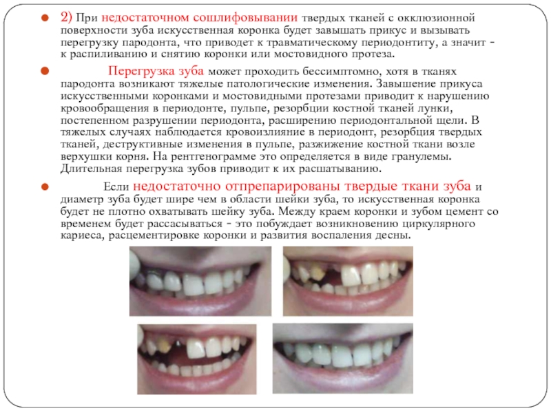 2) При недостаточном сошлифовывании твердых тканей с окклюзионной поверхности зуба искусственная коронка будет завышать прикус и вызывать