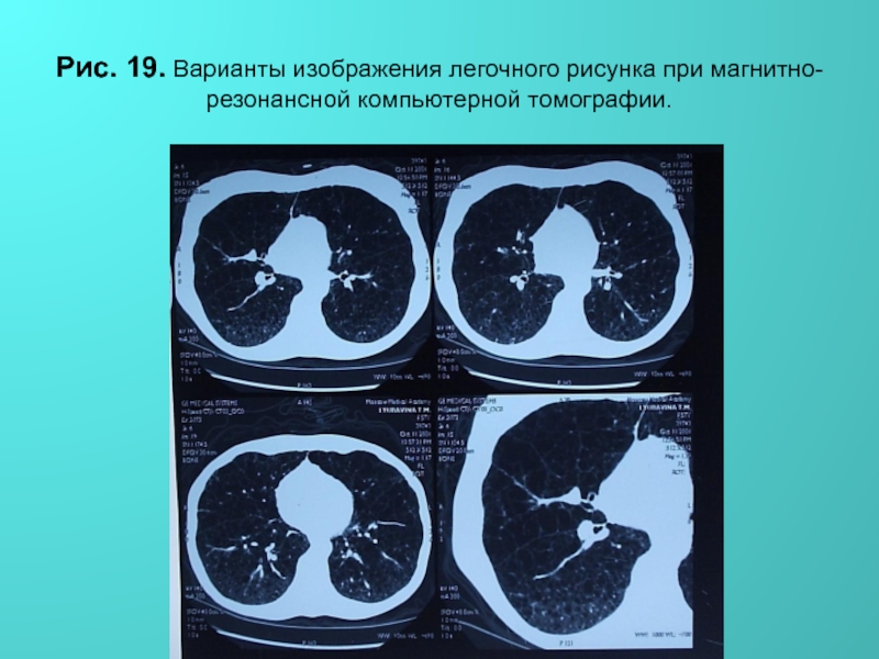 Патология легочного рисунка