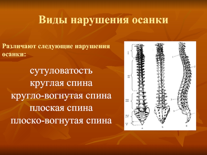 Сколиоз это поправимо проект по физкультуре