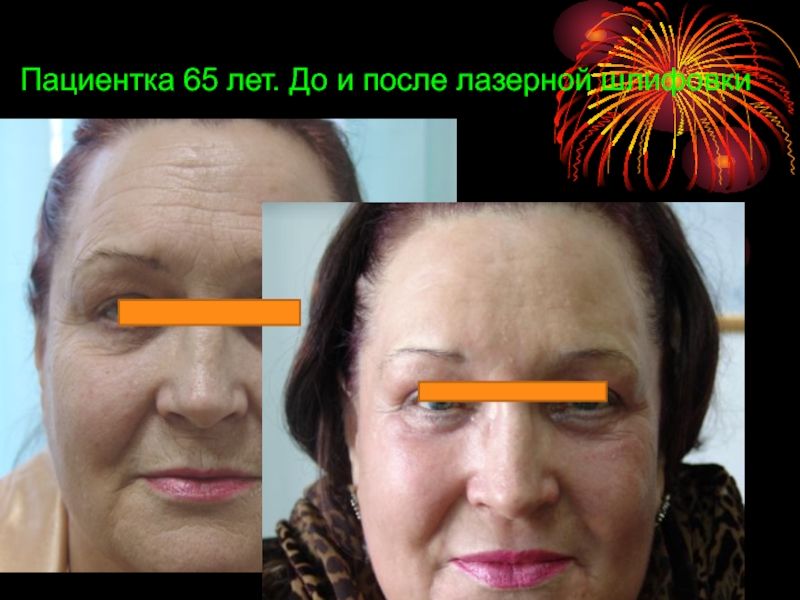 Пациентка 65 лет. До и после лазерной шлифовки