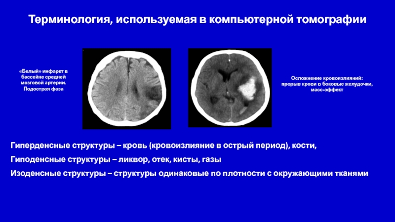 Гиперденсные структуры на кт изображениях