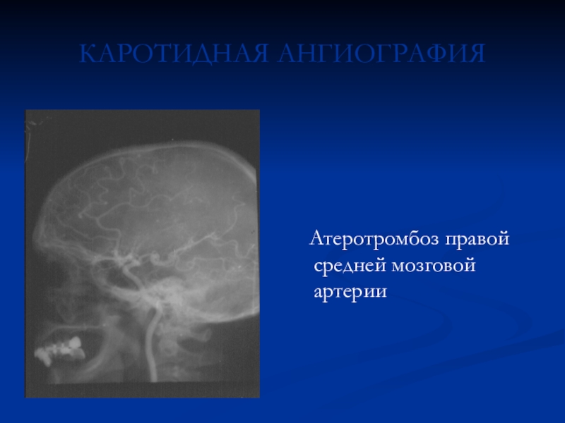 Ангиография средней мозговой артерии. Гипоплазия на ангиографии. Гипоплазия передней мозговой артерии. Аплазия правой средней мозговой артерии. Гипоплазия правой артерии мозга