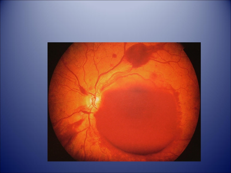 Аномалия развития зрительного нерва. Патологическая экскавация диска зрительного нерва. Глаукомная нейропатия зрительного нерва. Глаукоматозная экскавация зрительного нерва.