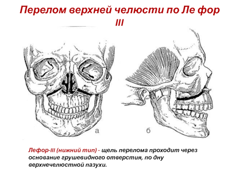 Перелом верхней челюсти по Ле фор III Лефор-III (нижний тип) - щель перелома проходит через основание грушевидного