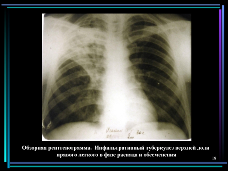 Реферат: Туберкулема правого легкого