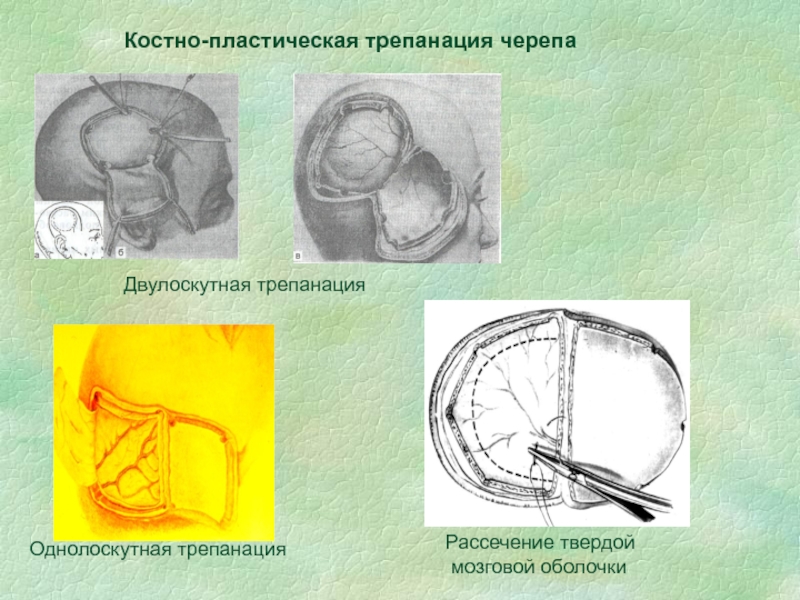 Костно пластическая трепанация черепа презентация