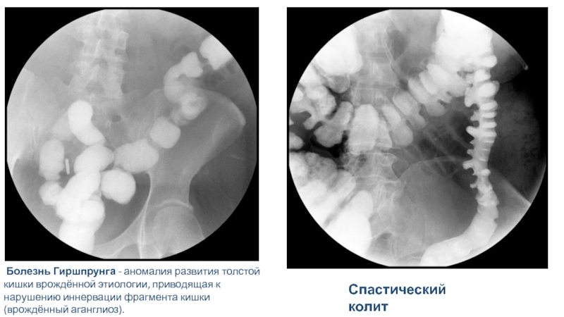 Схема изменений толстой кишки при болезни гиршпрунга