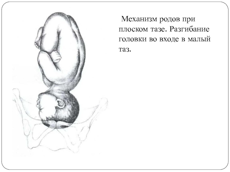 Механизм родов при плоском тазе. Разгибание головки во входе в малый таз. 