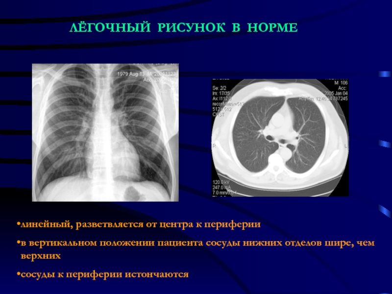 Усиление легочного рисунка в нижних отделах