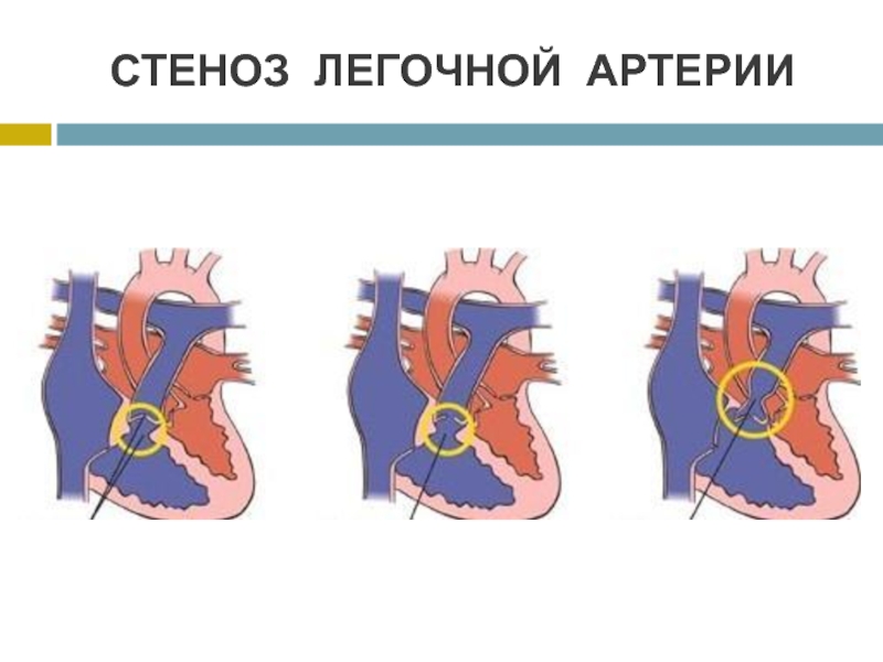 Стеноз аорты у детей презентация