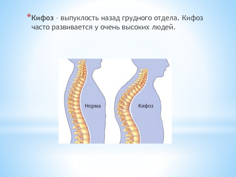 Степени кифоза. Кифоз. Причины кифоза. Торакальный кифоз.