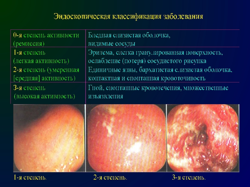 Воспалительные заболевания кишечника презентация