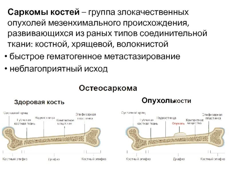 Саркомы мягких тканей презентация