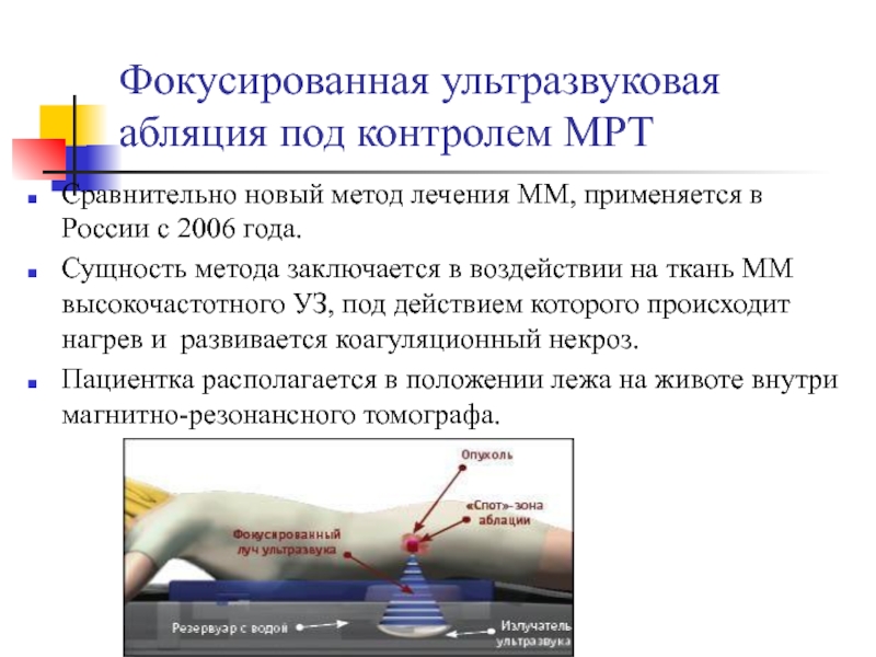 Фокусированная ультразвуковая абляция под контролем МРТСравнительно новый метод лечения ММ, применяется в России с 2006 года. Сущность