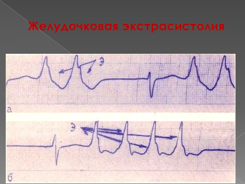 Желудочковая экстрасистолия картинки