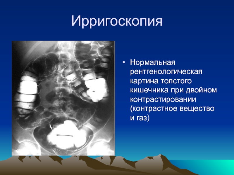 Болезнь крона пропедевтика презентация