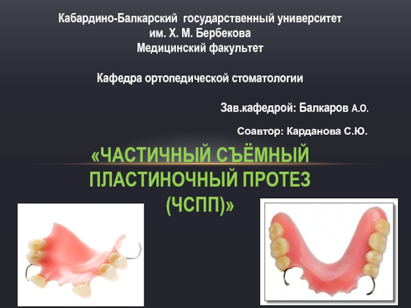 Частичный съёмный пластиночный протез (ЧСПП)