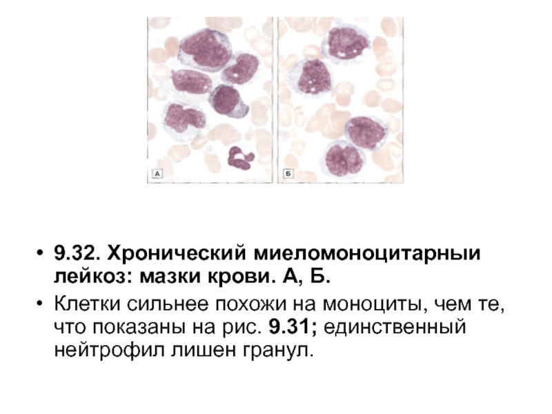 Хронический лейкоз рекомендации