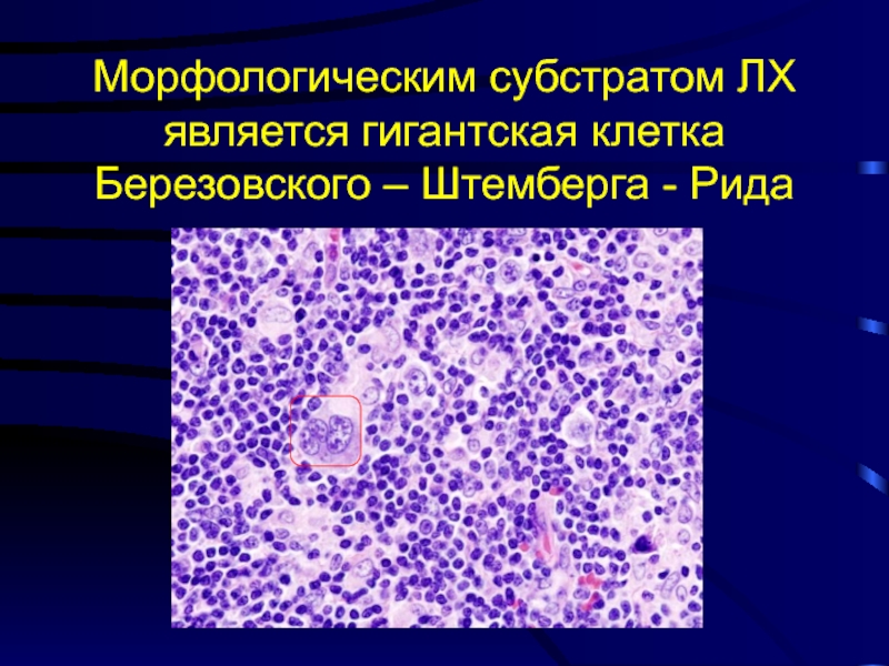 Морфологическим субстратом ЛХ является гигантская клетка Березовского – Штемберга - Рида