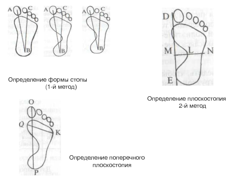 Форма стопы. Измерение стопы на плоскостопие. Метод определения поперечного плоскостопия. Методика определения нарушения плоскостопия. Методика определения степени плоскостопия.