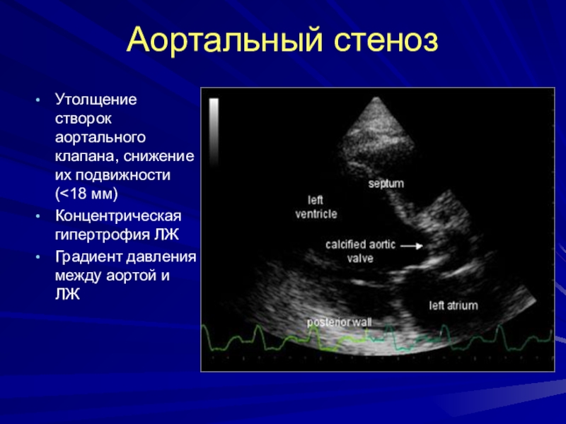 Уплотнение аорты сердца на узи